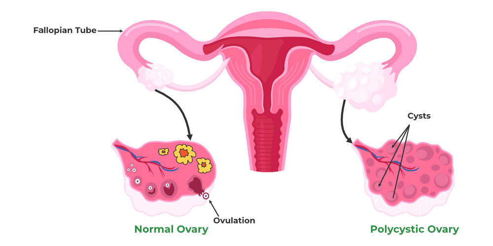 PCOD/PCOS WOMEN COMPLETE HEALTH GUIDE